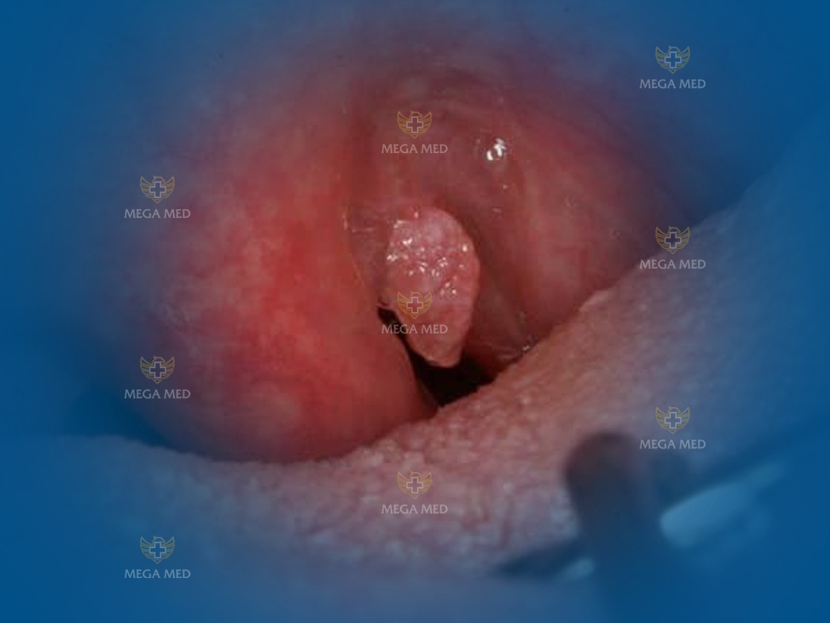 Sùi mào gà ở cổ họng